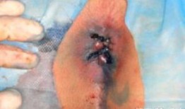 痔疮手术后可以吃瓜,瓜类美食的适宜与禁忌