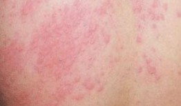 荨麻疹吃梨瓜,梨瓜助力缓解症状