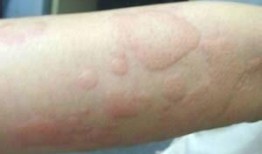 荨麻疹吃梨瓜,梨瓜助力缓解症状