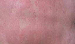 荨麻疹吃梨瓜,梨瓜助力缓解症状