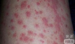 吃哈密瓜治疗过敏性紫癜,天然良方助治过敏性紫癜